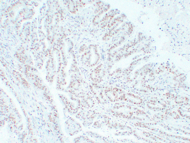 MSH6 Antibody - Colon Carcinoma 3