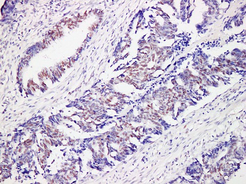MSH6 Antibody - Colon Carcinoma