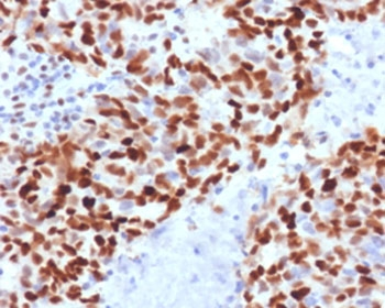 MSH6 Antibody - IHC staining of FFPE human colon carcinoma with MSH6 antibody (clone MTS6-1). HIER: boil tissue sections in pH6, 10mM citrate buffer, for 10-20 min and allow to cool before testing.