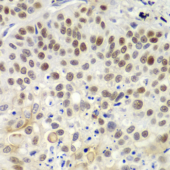 MSH6 Antibody - Immunohistochemistry of paraffin-embedded human lung cancer using MSH6 antibodyat dilution of 1:100 (40x lens).