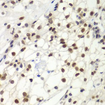 MSH6 Antibody - Immunohistochemistry of paraffin-embedded human kidney cancer using MSH6 antibodyat dilution of 1:100 (40x lens).