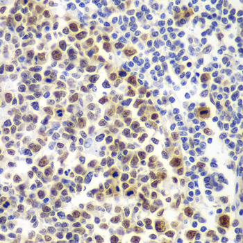 MSH6 Antibody - Immunohistochemistry of paraffin-embedded human amygdalitis using MSH6 antibodyat dilution of 1:100 (40x lens).