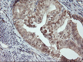 MSI1 / Musashi 1 Antibody - IHC of paraffin-embedded Adenocarcinoma of Human endometrium tissue using anti-MSI1 mouse monoclonal antibody.