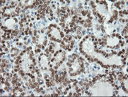 MSI1 / Musashi 1 Antibody - IHC of paraffin-embedded Carcinoma of Human thyroid tissue using anti-MSI1 mouse monoclonal antibody.