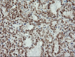 MSI1 / Musashi 1 Antibody - IHC of paraffin-embedded Carcinoma of Human thyroid tissue using anti-MSI1 mouse monoclonal antibody. (Heat-induced epitope retrieval by 10mM citric buffer, pH6.0, 100C for 10min).