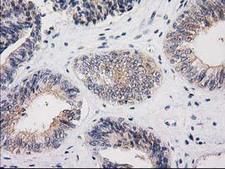 MSI1 / Musashi 1 Antibody - IHC of paraffin-embedded Adenocarcinoma of Human endometrium tissue using anti-MSI1 mouse monoclonal antibody. (Heat-induced epitope retrieval by 10mM citric buffer, pH6.0, 100C for 10min).