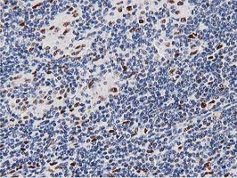 MSI1 / Musashi 1 Antibody - IHC of paraffin-embedded Human lymphoma tissue using anti-MSI1 mouse monoclonal antibody. (Heat-induced epitope retrieval by 10mM citric buffer, pH6.0, 100C for 10min).