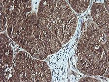 MSI2 Antibody - IHC of paraffin-embedded Adenocarcinoma of Human ovary tissue using anti-MSI2 mouse monoclonal antibody.