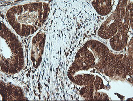 MSI2 Antibody - IHC of paraffin-embedded Carcinoma of Human pancreas tissue using anti-MSI2 mouse monoclonal antibody.