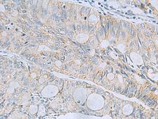 MSI2 Antibody - Immunohistochemistry of paraffin-embedded Human colorectal cancer tissue  using MSI2 Polyclonal Antibody at dilution of 1:60(×200)