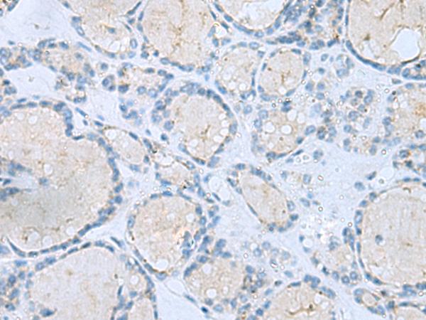 MSI2 Antibody - Immunohistochemistry of paraffin-embedded Human thyroid cancer tissue  using MSI2 Polyclonal Antibody at dilution of 1:60(×200)