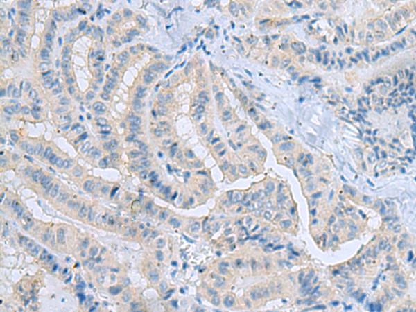 MSI2 Antibody - Immunohistochemistry of paraffin-embedded Human thyroid cancer tissue  using MSI2 Polyclonal Antibody at dilution of 1:70(×200)