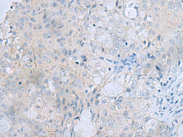 MSI2 Antibody - Immunohistochemistry of paraffin-embedded Human ovarian cancer tissue  using MSI2 Polyclonal Antibody at dilution of 1:70(×200)