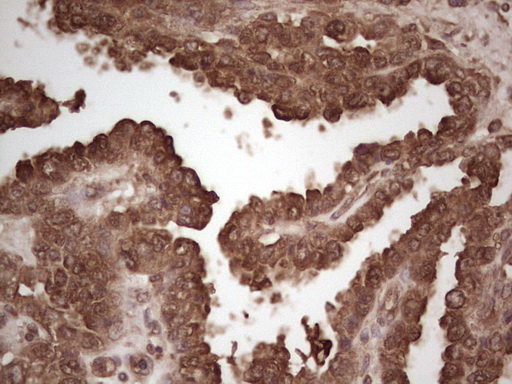 MSLN / Mesothelin Antibody - IHC of paraffin-embedded Adenocarcinoma of Human ovary tissue using anti-MSLN mouse monoclonal antibody. (heat-induced epitope retrieval by 1 mM EDTA in 10mM Tris, pH8.5, 120°C for 3min).