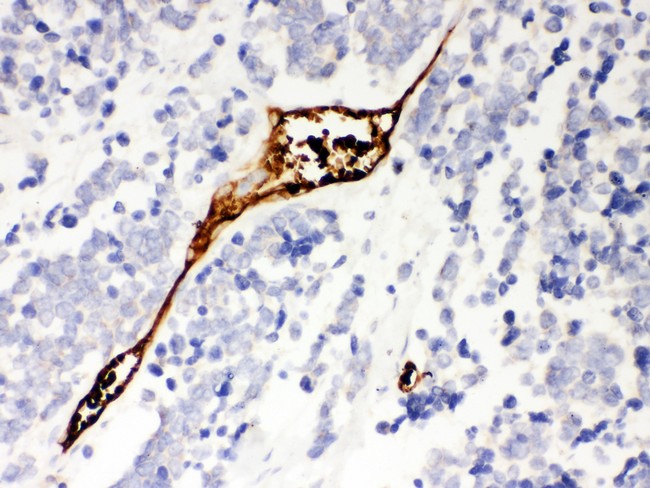 MSLN / Mesothelin Antibody - Mesothelin antibody IHC-paraffin: Human Lung Cancer Tissue.