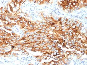 MSLN / Mesothelin Antibody - IHC testing of FFPE human lung mesothelioma with Mesothelin antibody (clone MSLN/2131). HIER: boil tissue sections in pH6, 10mM citrate buffer, for 10-20 min followed by cooling at RT for 20 min.