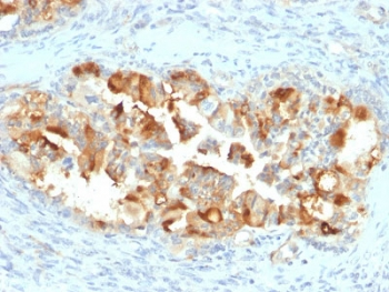 MSLN / Mesothelin Antibody - IHC testing of FFPE human endometrial carcinoma with Mesothelin antibody (clone MSLN/2131). HIER: boil tissue sections in pH6, 10mM citrate buffer, for 10-20 min followed by cooling at RT for 20 min.