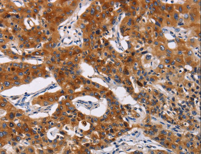 MSLN / Mesothelin Antibody - Immunohistochemistry of paraffin-embedded Human lung cancer using MSLN Polyclonal Antibody at dilution of 1:50.