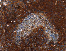 MSLN / Mesothelin Antibody - Immunohistochemistry of paraffin-embedded Human lung cancer using MSLN Polyclonal Antibody at dilution of 1:40.