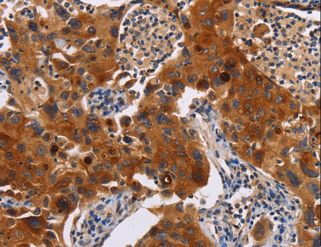 MSLN / Mesothelin Antibody - Immunohistochemistry of paraffin-embedded Human lung cancer using MSLN Polyclonal Antibody at dilution of 1:40.