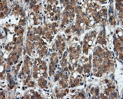 MSMB / MSP Antibody - Immunohistochemical staining of paraffin-embedded Carcinoma of liver tissue using anti-MSMB mouse monoclonal antibody. (Dilution 1:50).