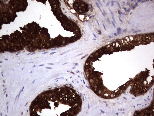 MSMB / MSP Antibody - Immunohistochemical staining of paraffin-embedded Carcinoma of Human prostate tissue using anti-MSMB mouse monoclonal antibody.  heat-induced epitope retrieval by 1 mM EDTA in 10mM Tris, pH9.0, 120C for 3min)