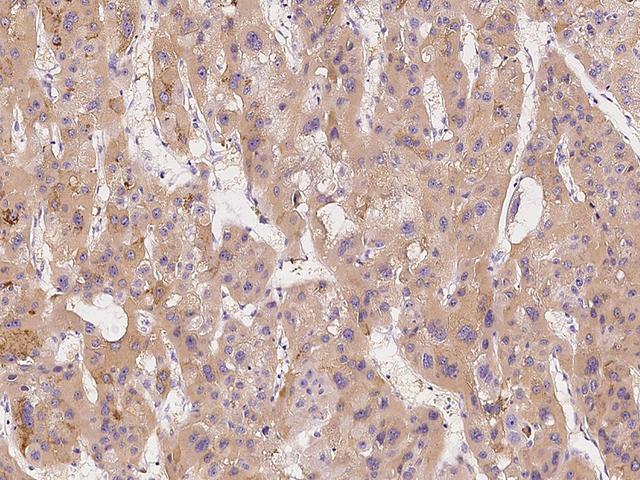 MSMB / MSP Antibody - Immunochemical staining of human MSMB in human hepatoma with rabbit polyclonal antibody at 1:1000 dilution, formalin-fixed paraffin embedded sections.