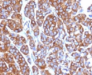 MSN / Moesin Antibody - IHC testing of FFPE human melanoma with Moesin antibody (clone EDLP70).  This image was taken for the unmodified form of this product. Other forms have not been tested.