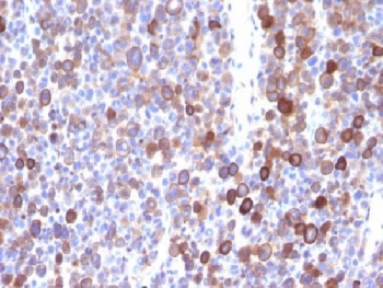 MSN / Moesin Antibody - IHC testing of FFPE human melanoma with Moesin antibody (clone MSN/491). Required HIER: boil tissue sections in 10mM citrate buffer, pH 6, for 10-20 min.