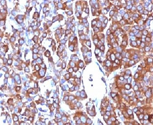 MSN / Moesin Antibody - Formalin-fixed, paraffin-embedded human melanoma stained with Moesin antibody (MSN/492).  This image was taken for the unmodified form of this product. Other forms have not been tested.
