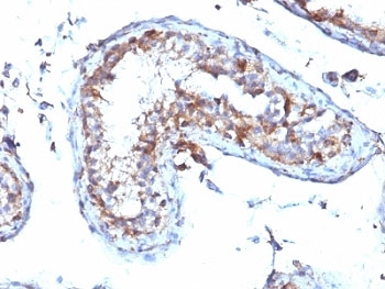MSN / Moesin Antibody - Formalin-fixed, paraffin-embedded human testicular carcinoma stained with Moesin antibody (MSN/492).  This image was taken for the unmodified form of this product. Other forms have not been tested.