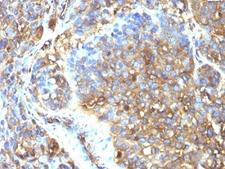 MSN / Moesin Antibody - Formalin-fixed, paraffin-embedded human melanoma stained with Moesin antibody (MSN/493).  This image was taken for the unmodified form of this product. Other forms have not been tested.