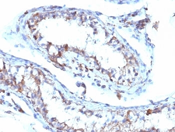 MSN / Moesin Antibody - Formalin-fixed, paraffin-embedded human testicular carcinoma stained with Moesin antibody (MSN/493).  This image was taken for the unmodified form of this product. Other forms have not been tested.