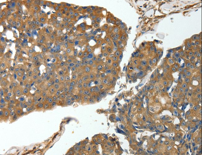 MSN / Moesin Antibody - Immunohistochemistry of paraffin-embedded Human breast cancer using MSN Polyclonal Antibody at dilution of 1:30.