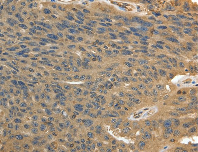 MSN / Moesin Antibody - Immunohistochemistry of paraffin-embedded Human ovarian cancer using MSN Polyclonal Antibody at dilution of 1:30.