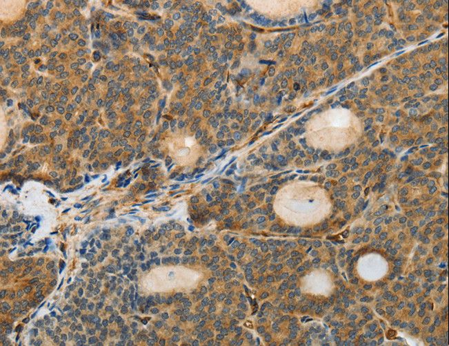 MSN / Moesin Antibody - Immunohistochemistry of paraffin-embedded Human thyroid cancer using MSN Polyclonal Antibody at dilution of 1:30.
