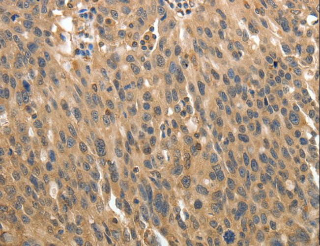 MSN / Moesin Antibody - Immunohistochemistry of paraffin-embedded Human ovarian cancer using MSN Polyclonal Antibody at dilution of 1:30.