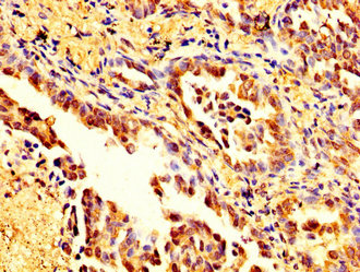 MSN / Moesin Antibody - Immunohistochemistry image at a dilution of 1:200 and staining in paraffin-embedded human lung cancer performed on a Leica BondTM system. After dewaxing and hydration, antigen retrieval was mediated by high pressure in a citrate buffer (pH 6.0) . Section was blocked with 10% normal goat serum 30min at RT. Then primary antibody (1% BSA) was incubated at 4 °C overnight. The primary is detected by a biotinylated secondary antibody and visualized using an HRP conjugated SP system.