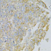 MSN / Moesin Antibody - Immunohistochemistry of paraffin-embedded human liver cancer using MSN antibody at dilution of 1:100 (40x lens).