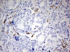 MSR1 / CD204 Antibody - IHC of paraffin-embedded Adenocarcinoma of Human breast tissue using anti-MSR1 mouse monoclonal antibody. (Heat-induced epitope retrieval by 10mM citric buffer, pH6.0, 120°C for 3min).