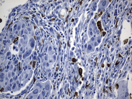 MSR1 / CD204 Antibody - Immunohistochemical staining of paraffin-embedded Carcinoma of Human lung tissue using anti-MSR1 mouse monoclonal antibody. (Heat-induced epitope retrieval by 1mM EDTA in 10mM Tris buffer. (pH8.5) at 120°C for 3 min. (1:1200)