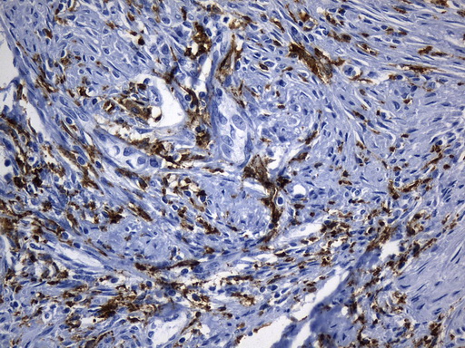 MSR1 / CD204 Antibody - Immunohistochemical staining of paraffin-embedded Adenocarcinoma of Human endometrium tissue using anti-MSR1 mouse monoclonal antibody. (Heat-induced epitope retrieval by 1mM EDTA in 10mM Tris buffer. (pH8.5) at 120°C for 3 min. (1:1200)