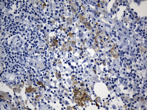 MSR1 / CD204 Antibody - Immunohistochemical staining of paraffin-embedded Carcinoma of Human bladder tissue using anti-MSR1 mouse monoclonal antibody. (Heat-induced epitope retrieval by 1mM EDTA in 10mM Tris buffer. (pH8.5) at 120°C for 3 min. (1:1200)