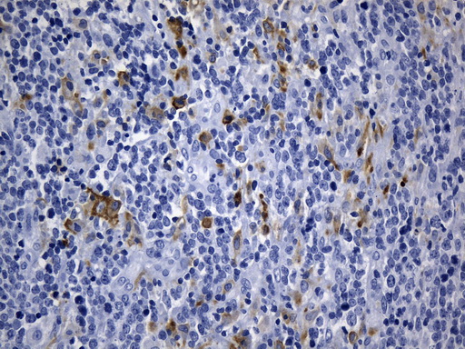 MSR1 / CD204 Antibody - Immunohistochemical staining of paraffin-embedded Human lymphoma tissue using anti-MSR1 mouse monoclonal antibody. (Heat-induced epitope retrieval by 1mM EDTA in 10mM Tris buffer. (pH8.5) at 120°C for 3 min. (1:1200)