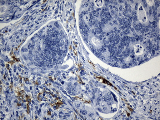 MSR1 / CD204 Antibody - Immunohistochemical staining of paraffin-embedded Adenocarcinoma of Human colon tissue using anti-MSR1 mouse monoclonal antibody. (Heat-induced epitope retrieval by 1mM EDTA in 10mM Tris buffer. (pH8.5) at 120°C for 3 min. (1:1200)