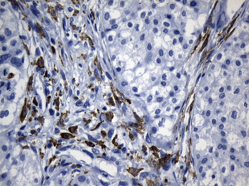 MSR1 / CD204 Antibody - Immunohistochemical staining of paraffin-embedded Human Kidney tissue within the normal limits using anti-MSR1 mouse monoclonal antibody. (Heat-induced epitope retrieval by 1mM EDTA in 10mM Tris buffer. (pH8.5) at 120°C for 3 min. (1:1200)