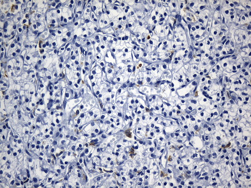 MSR1 / CD204 Antibody - Immunohistochemical staining of paraffin-embedded Carcinoma of Human kidney tissue using anti-MSR1 mouse monoclonal antibody. (Heat-induced epitope retrieval by 1mM EDTA in 10mM Tris buffer. (pH8.5) at 120°C for 3 min. (1:1200)