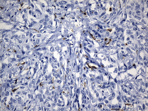 MSR1 / CD204 Antibody - Immunohistochemical staining of paraffin-embedded Carcinoma of Human liver tissue using anti-MSR1 mouse monoclonal antibody. (Heat-induced epitope retrieval by 1mM EDTA in 10mM Tris buffer. (pH8.5) at 120°C for 3 min. (1:1200)