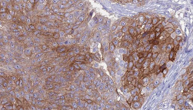 MSR1 / CD204 Antibody - 1:100 staining human urothelial carcinoma tissue by IHC-P. The sample was formaldehyde fixed and a heat mediated antigen retrieval step in citrate buffer was performed. The sample was then blocked and incubated with the antibody for 1.5 hours at 22°C. An HRP conjugated goat anti-rabbit antibody was used as the secondary.