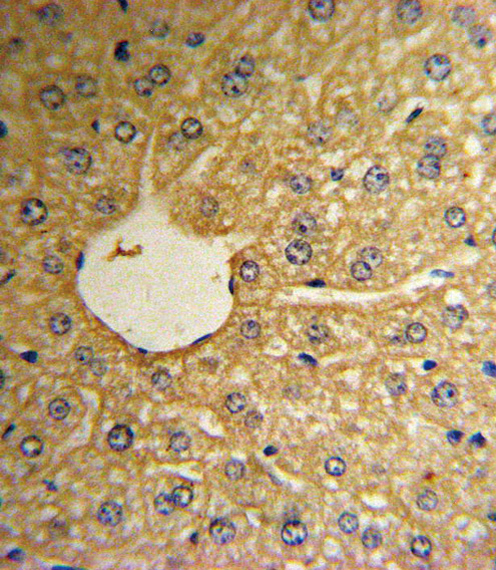 MSRA Antibody - Formalin-fixed and paraffin-embedded human hepatocarcinoma reacted with MSRA Antibody , which was peroxidase-conjugated to the secondary antibody, followed by DAB staining. This data demonstrates the use of this antibody for immunohistochemistry; clinical relevance has not been evaluated.